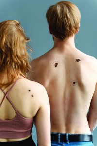 back view young people with melanoma